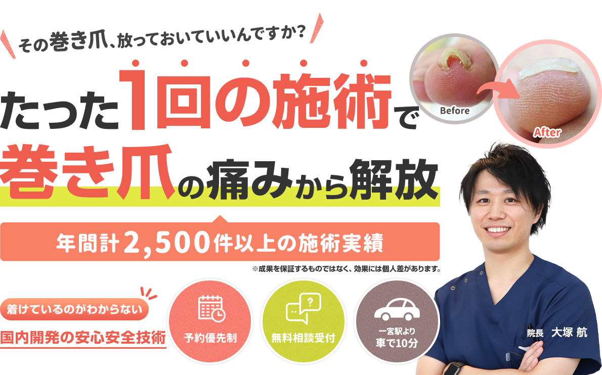 たった1回の施術で巻き爪の痛みから解放